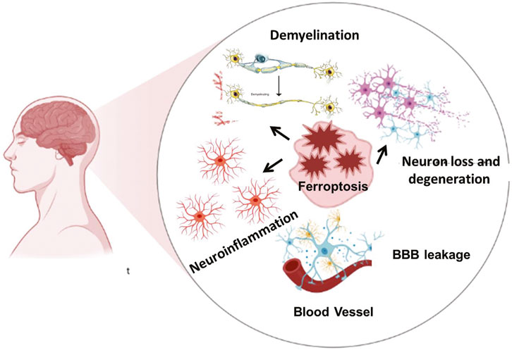 Diagram illustrating neurological damage processes. A human profile with an inset displaying brain impact including demyelination, ferroptosis, and neuroinflammation. Arrows indicate connections to neuron loss, degeneration, blood-brain barrier leakage, and blood vessel issues.
