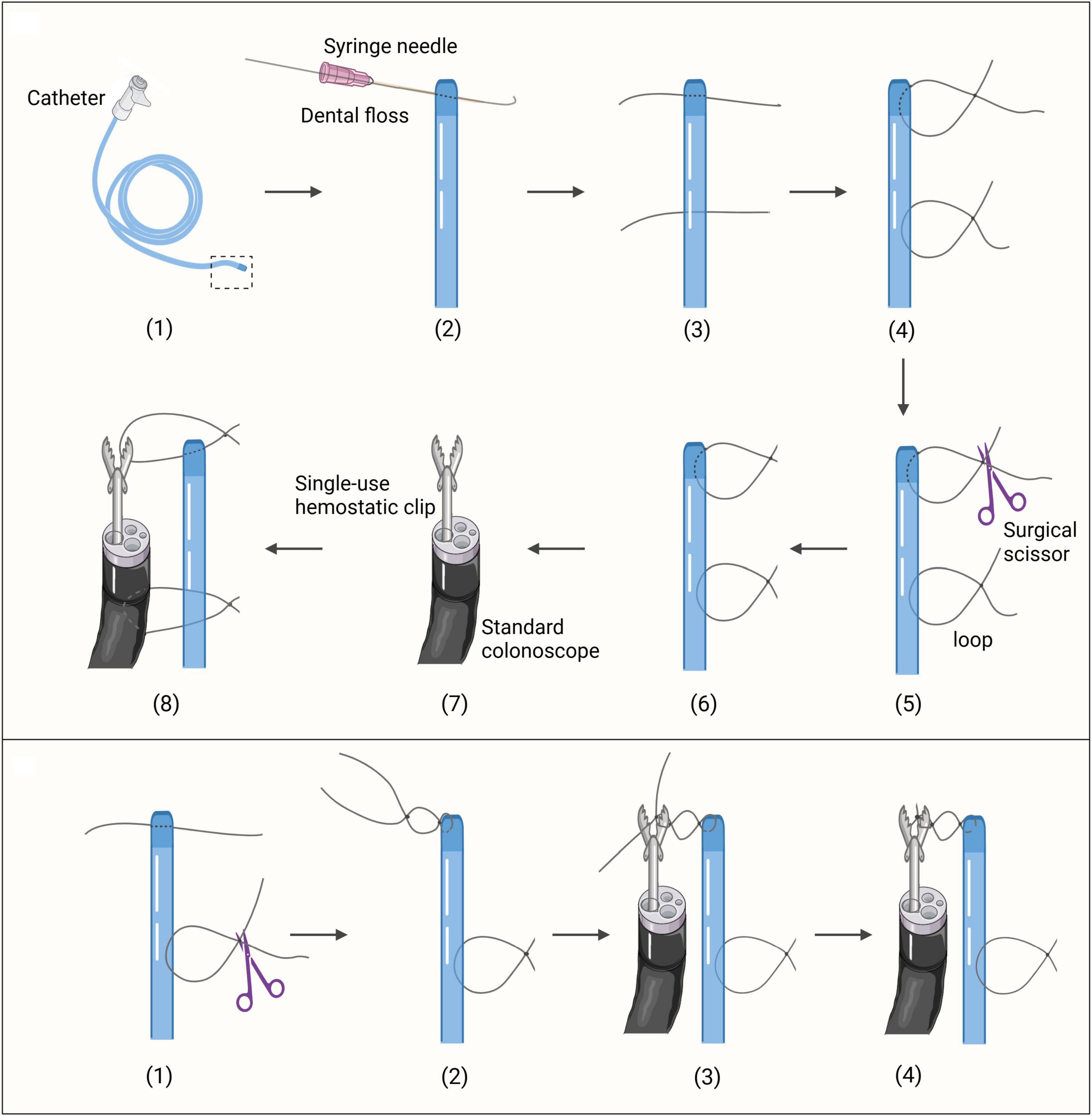 Illustration of catheter securement procedures. Top: The DLC method, after preparing a catheter, a single-use hemostatic clip directly clamps the catheter’s loop. Bottom: The initial steps (1)-(3) align with the DLC method. Subsequent steps involve binding the catheter loop with dental floss to the hemostatic clip. This completes the securment in the CLB method.