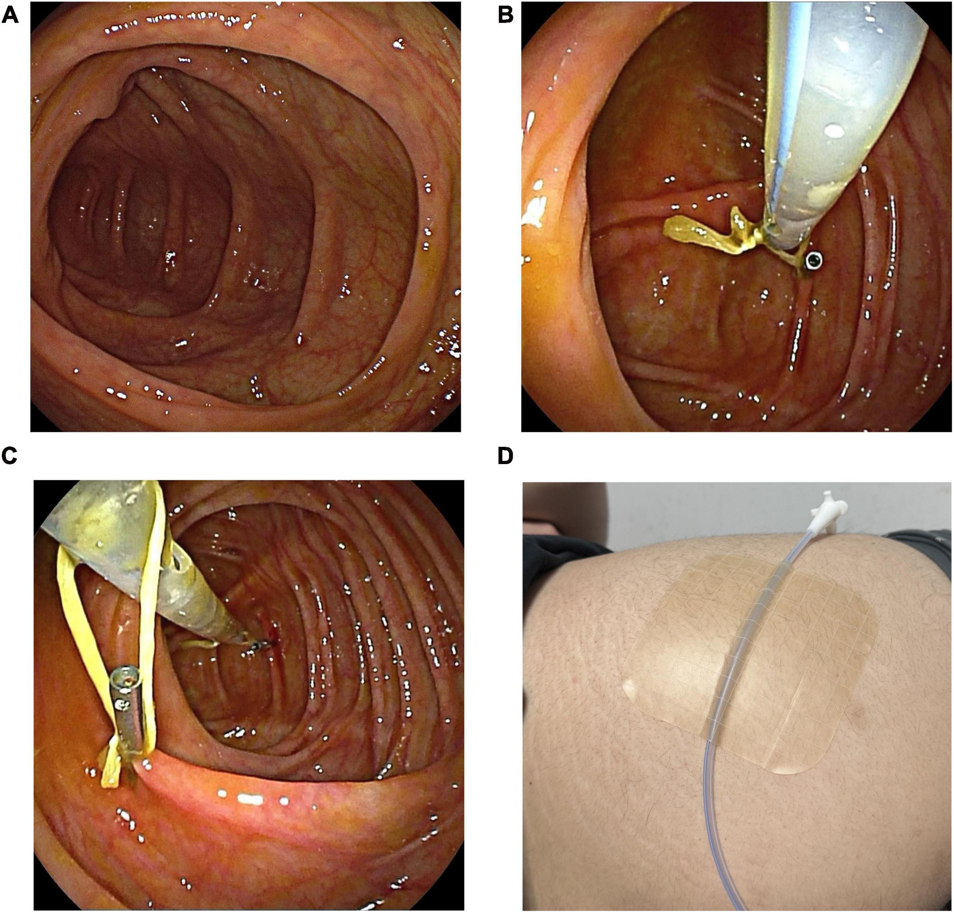 Colonoscopically guided catheter placement. A: Catheter reaches the ileocecal region under colonoscopic guidance. B: First loop secured to the colonic wall. C: Second loop secured. D: Catheter’s distal end attached to buttock skin with medical tape.