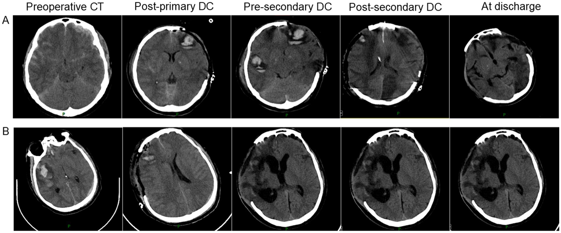 CT scan images show a series of five brain scans over time for two patients, labeled A and B. Each row progresses from preoperative CT, post-primary decompressive craniectomy (DC), pre-extended DC, post-extended DC, to at discharge. The images illustrate changes in brain structure and swelling reduction after surgeries.