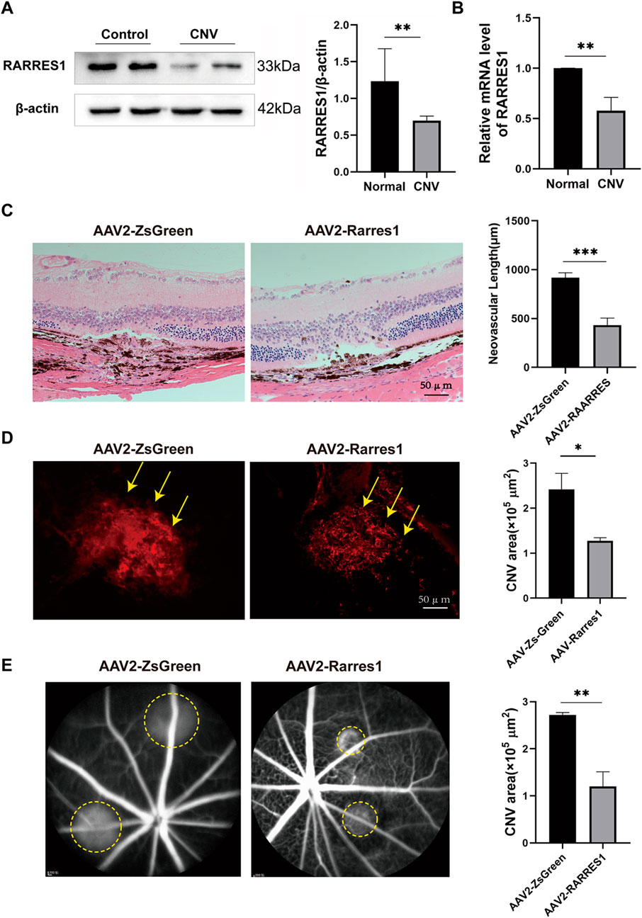 Composite image showing experimental results in a study. Panel A displays Western blot bands for RARRES1 and β-actin with a bar graph comparing their expression in control and CNV conditions, showing significant differences. Panel B shows a bar graph for relative mRNA levels of RARRES1 in normal and CNV tissues, indicating a reduction in CNV. Panel C features histological images of eye tissue under AAV2-ZsGreen and AAV2-Rarres1 treatments, with a bar graph showing decreased neovascular length in AAV2-Rarres1. Panel D presents fluorescence images with arrows indicating CNV areas and a graph showing reduced CNV area in AAV2-Rarres1. Panel E has angiography images with yellow circles highlighting affected areas and a graph showing smaller CNV areas for AAV2-Rarres1. Scale bars and significance levels are marked.