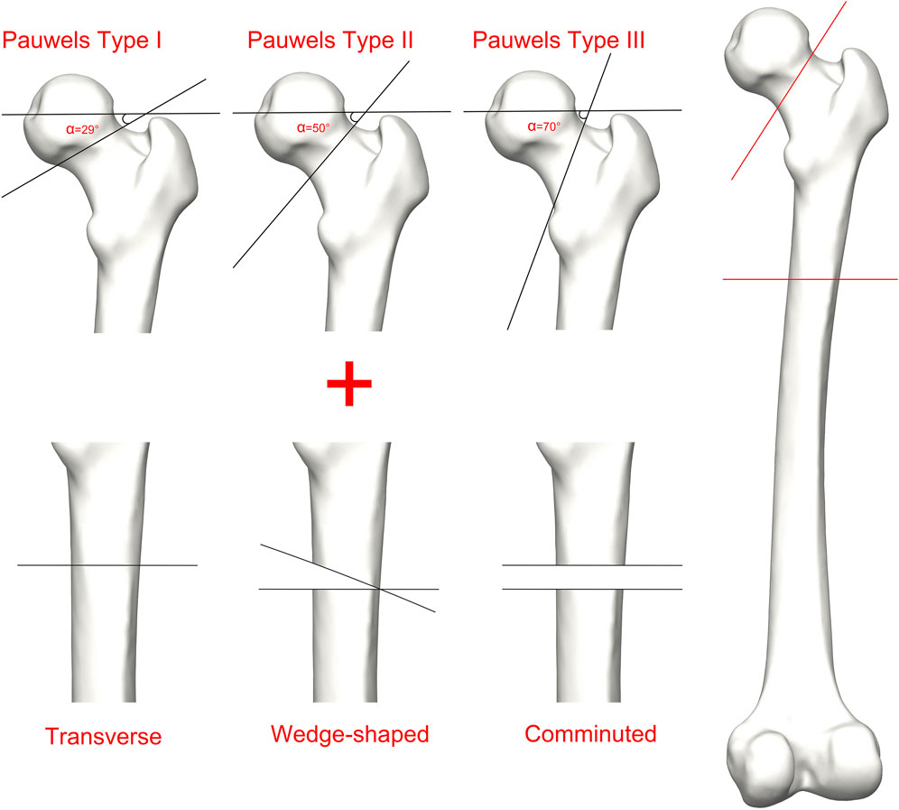 Diagram illustrating Pauwels classification of femoral neck fractures and fracture patterns. The top row shows three femur necks with varying inclination angles: Type I at 29 degrees, Type II at 50 degrees, and Type III at 70 degrees. The bottom row indicates fracture patterns: transverse, wedge-shaped, and comminuted. A full femur is displayed on the right with red lines indicating fracture angles.