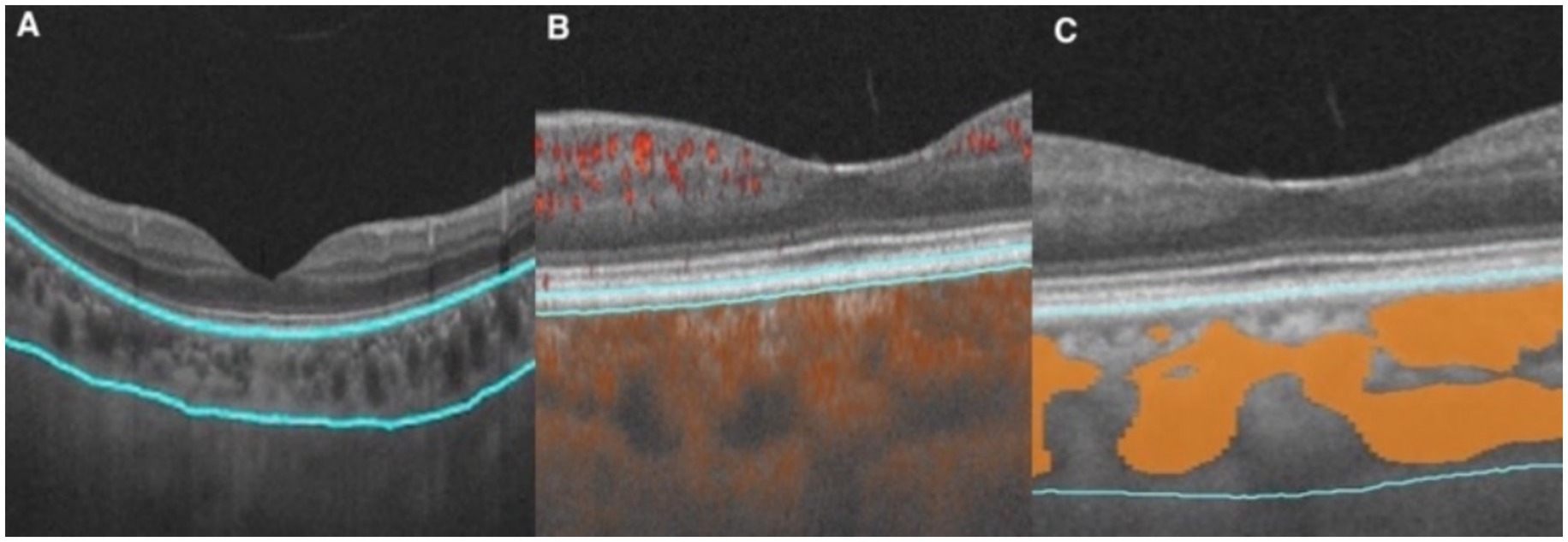 Three optical coherence tomography (OCT) images of the eye labeled A, B, and C. Image A displays a standard cross-section with blue demarcated lines. Image B shows red and orange areas indicating blood flow and anomalies. Image C highlights larger orange regions beneath the retina, likely representing fluid accumulation.