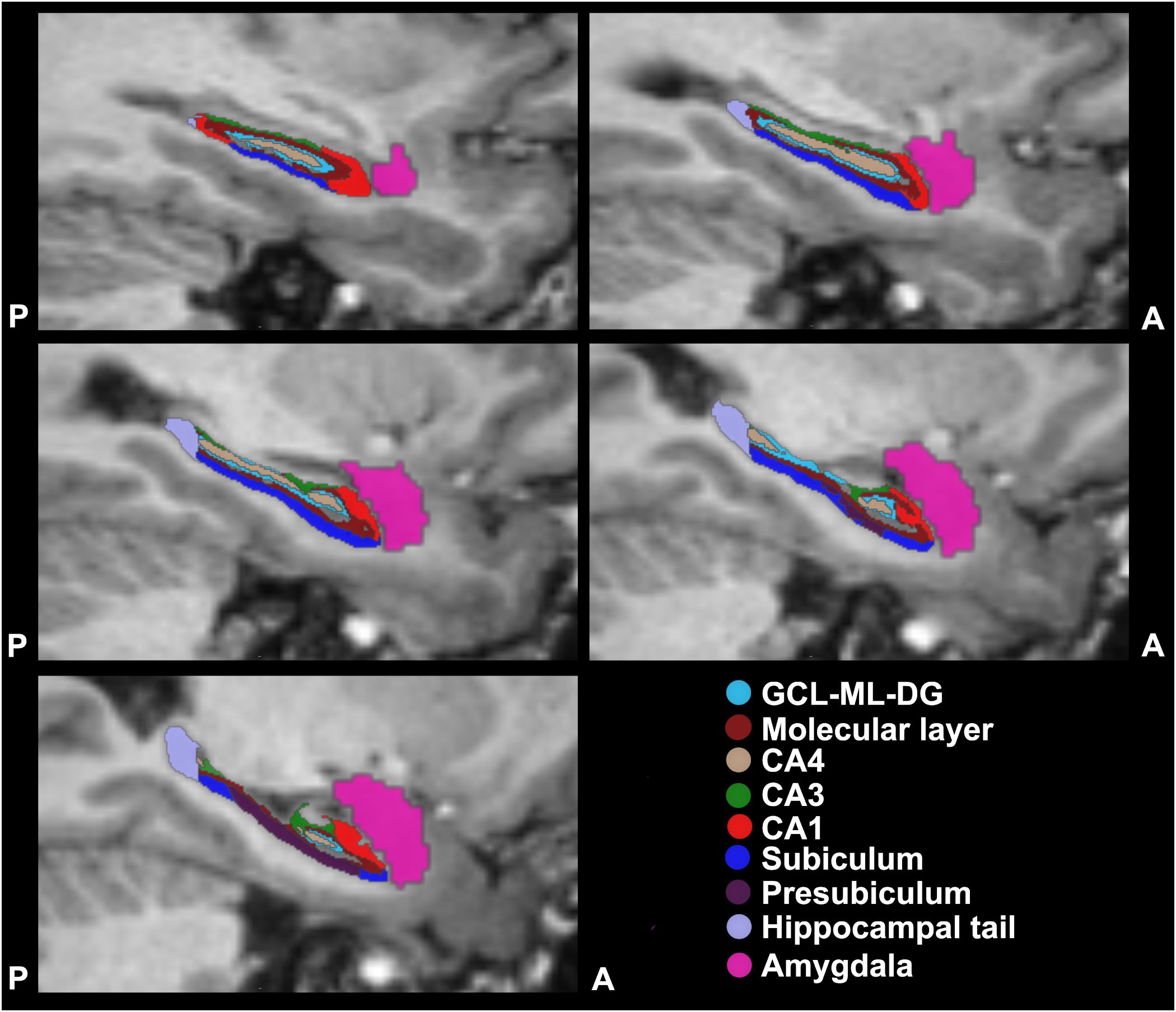 MRI brain scans in five panels showing colored regions representing different brain areas: GCL-ML-DG, Molecular layer, CA4, CA3, CA1, Subiculum, Presubiculum, Hippocampal tail, and Amygdala. Each region is color coded with a legend indicating their corresponding hues. Labels“P” and“A” denote posterior and anterior directions.
