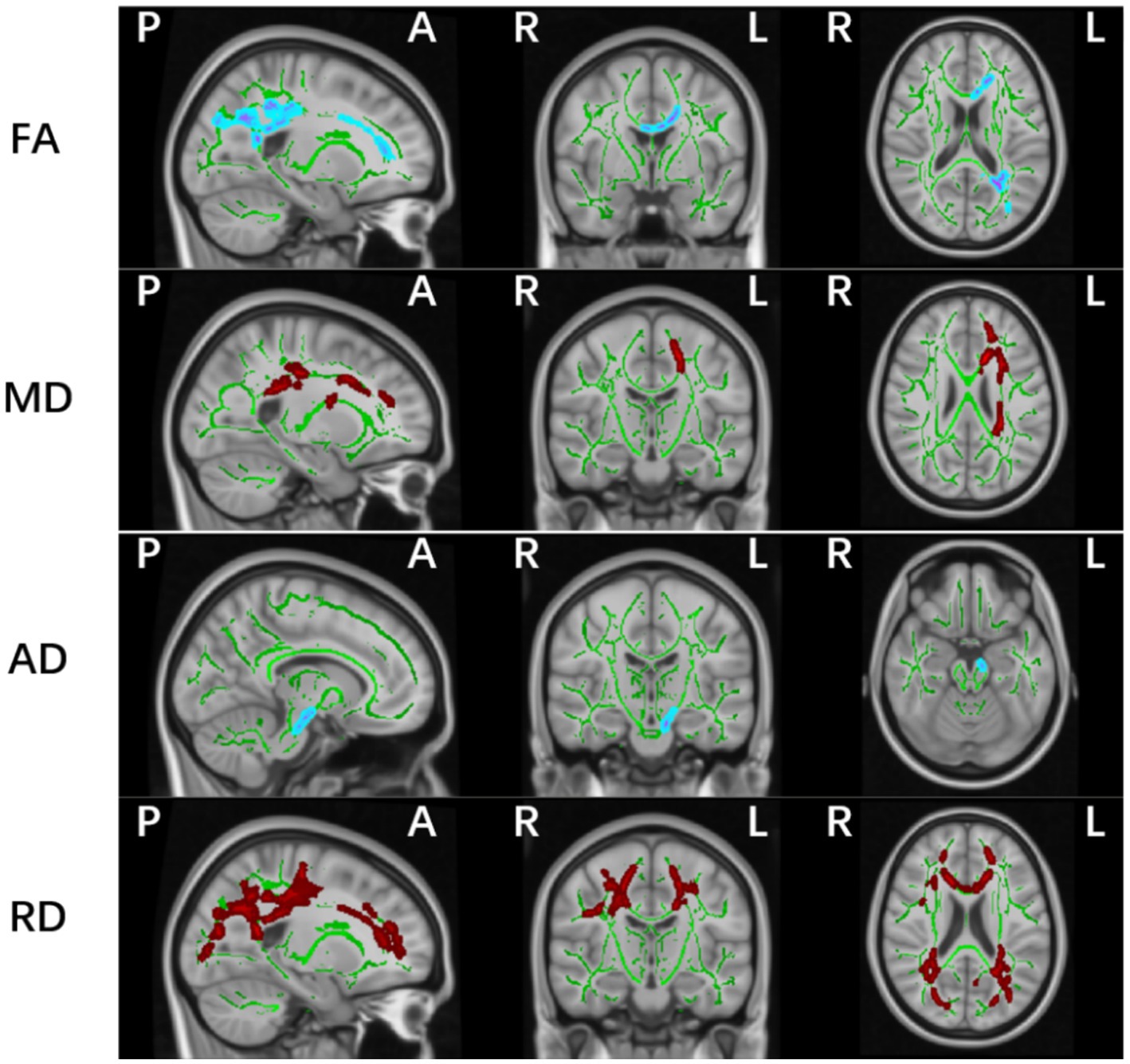 Brain MRI scans displaying four different diffusion tensor imaging metrics: FA, MD, AD, and RD. Each row shows multiple cross-sections, highlighting specific brain regions in colored overlays (blue and red), with directional views labeled P (posterior), A (anterior), R (right), and L (left).