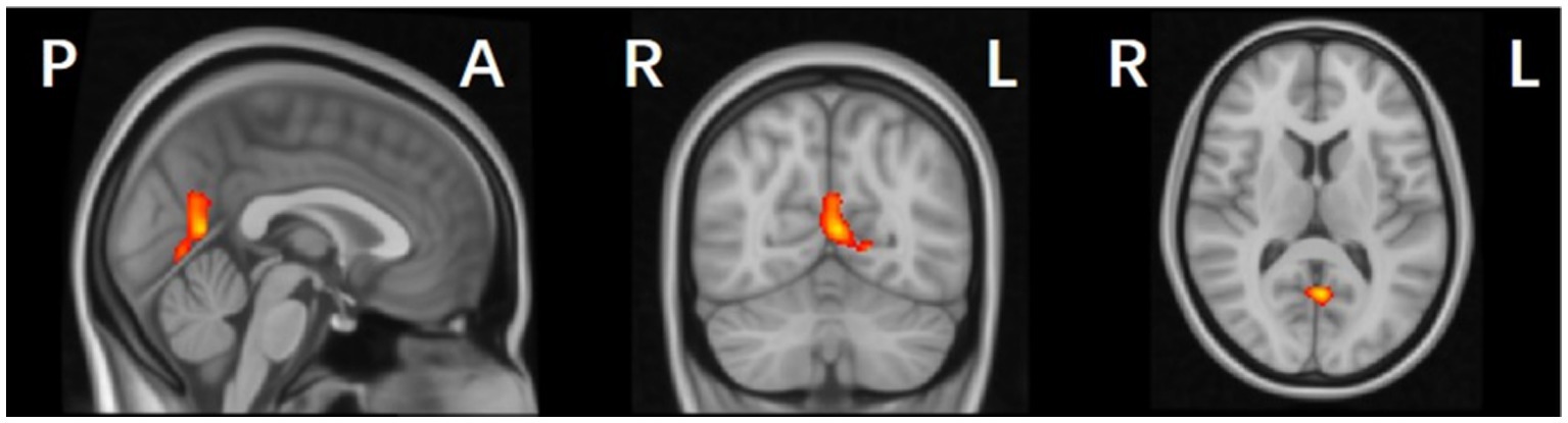 Three MRI brain scans showing activation areas highlighted in red and yellow. The first scan is a sagittal view, the second is a coronal view, and the third is an axial view. Labels indicate lateral sides: P for posterior, A for anterior, R for right, and L for left.