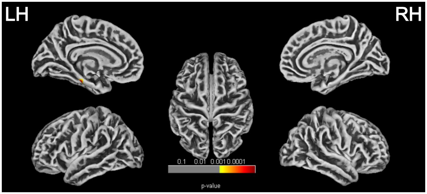 MRI brain scans showing side and top views of left (LH) and right hemispheres (RH). A color scale indicating p-values is present, ranging from gray to red, marked by red and yellow in one area on the left hemisphere.