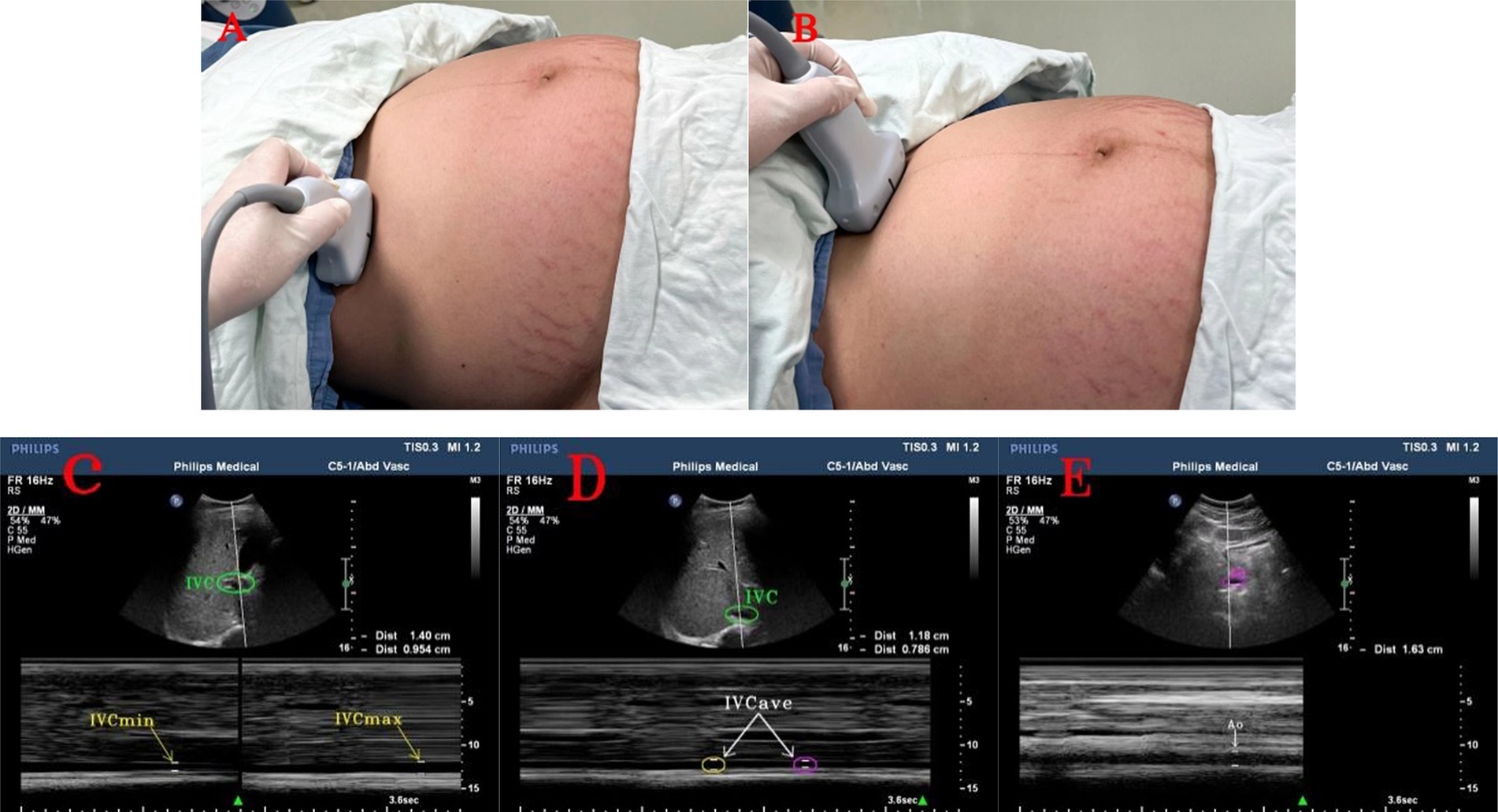 Panels A and B show a person undergoing abdominal ultrasound with a transducer. Panels C, D, and E display ultrasound images. Panel C shows measurements of the inferior vena cava (IVC), panel D depicts the IVC with labels for IVCave, and panel E presents another ultrasound image labeled with “Ao,” likely indicating the aorta. Labels and measurements are present, highlighting key anatomical features.