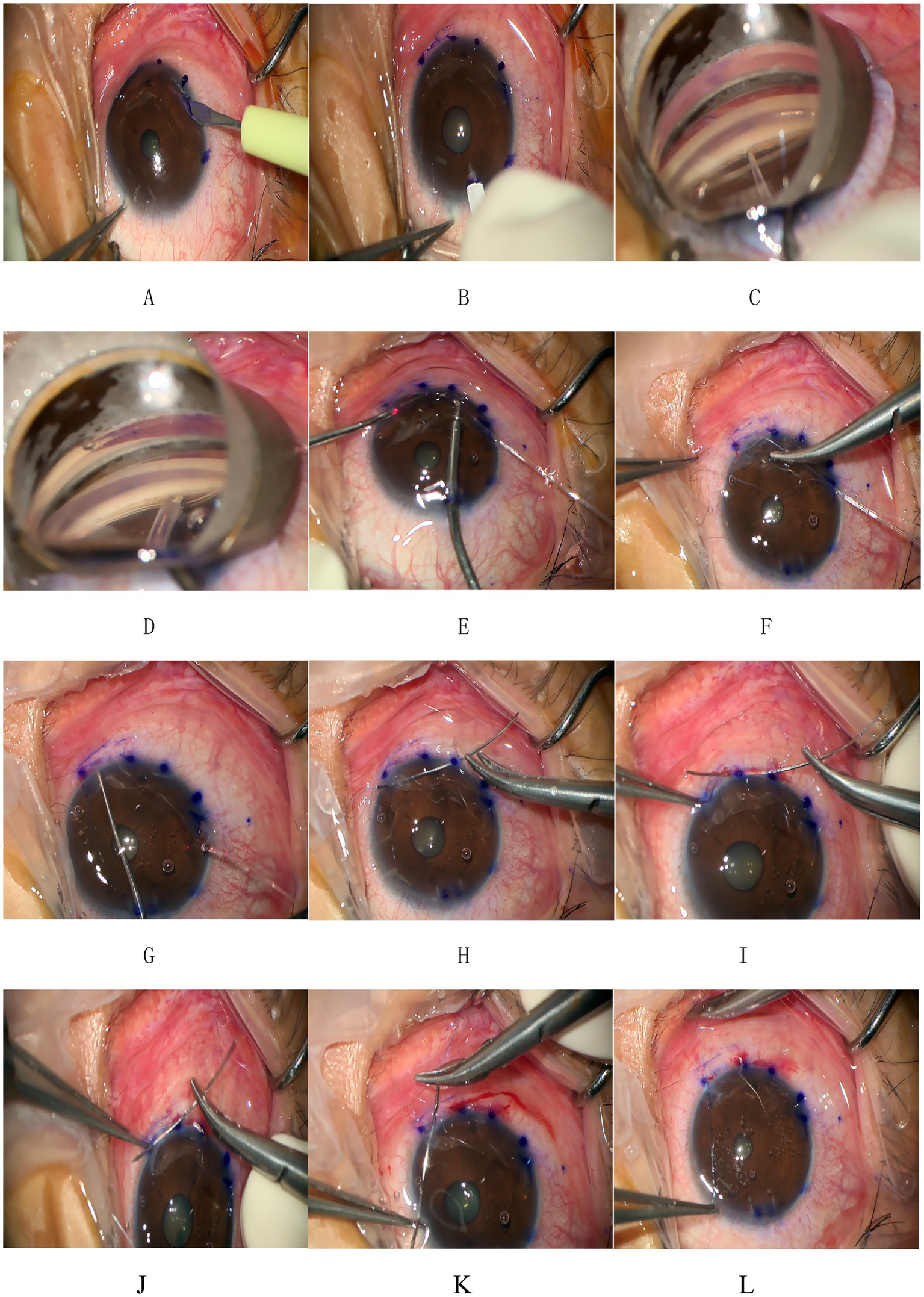 Sequential images A to L depict steps in an ocular surgery. Instruments manipulate the eye tissue, with blue ink marking precise locations. The images show incisions, sutures, and adjustments on the eye's surface under magnification, demonstrating surgical techniques and processes involved.