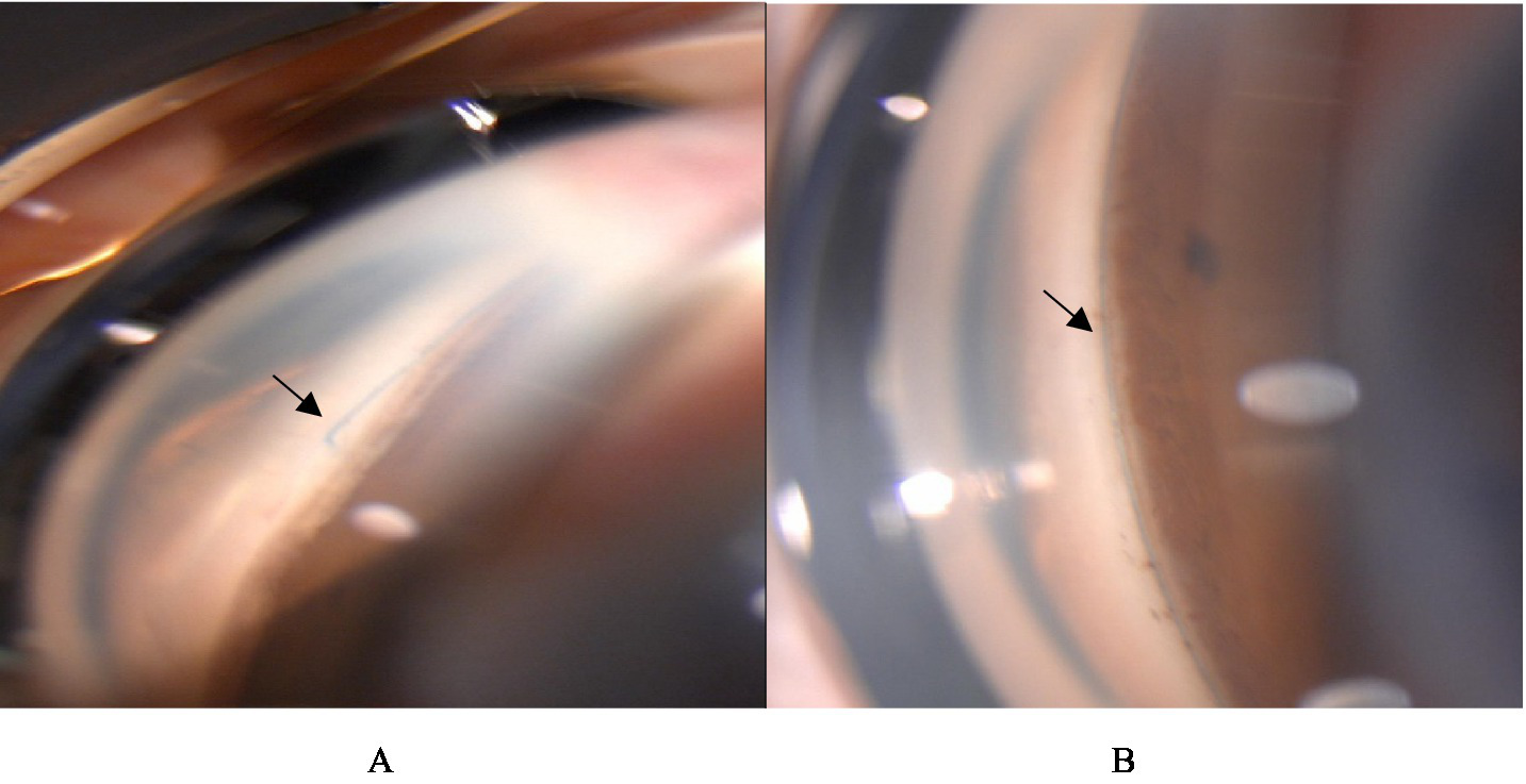 Two gonioscopic images taken 1 month after 3T surgery from the same eye. Panel A shows a black arrow pointing to the site where the suture emerges from the trabecular meshwork fenestration window. Panel B shows a black arrow indicating the location of the suture within Schlemm’s canal. The surrounding angle structures are visible for orientation, including the trabecular meshwork and adjacent tissue.