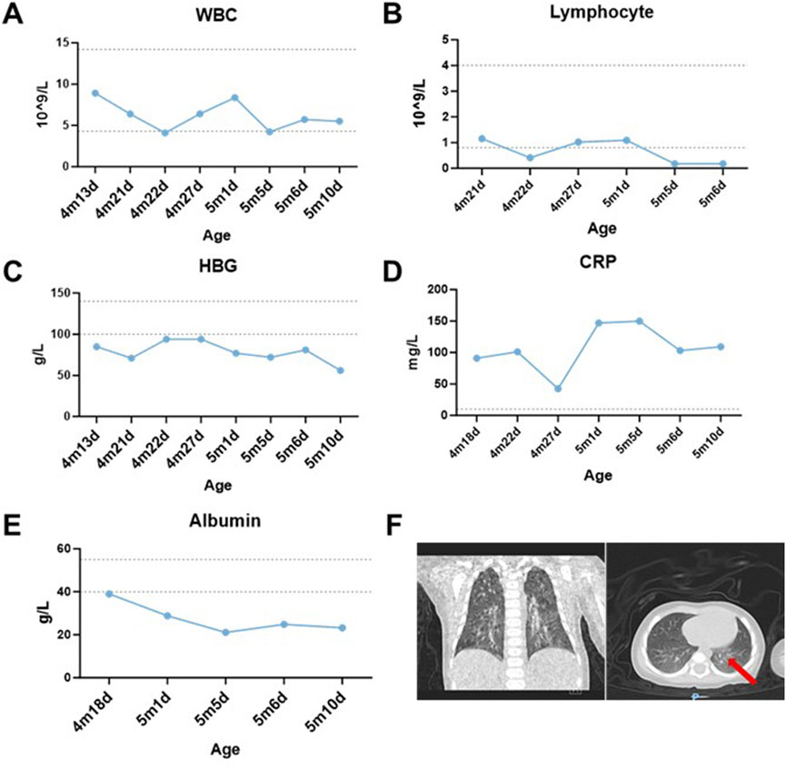 Graphs A to E show lab measurements over time,including WBC, Lymphocyte, HBG, CRP, and Albumin levels. Each graph displays fluctuations at different age points. Graph F presents medical imaging of the chest, with a red arrow indicating the most prominent area of pulmonary infection.