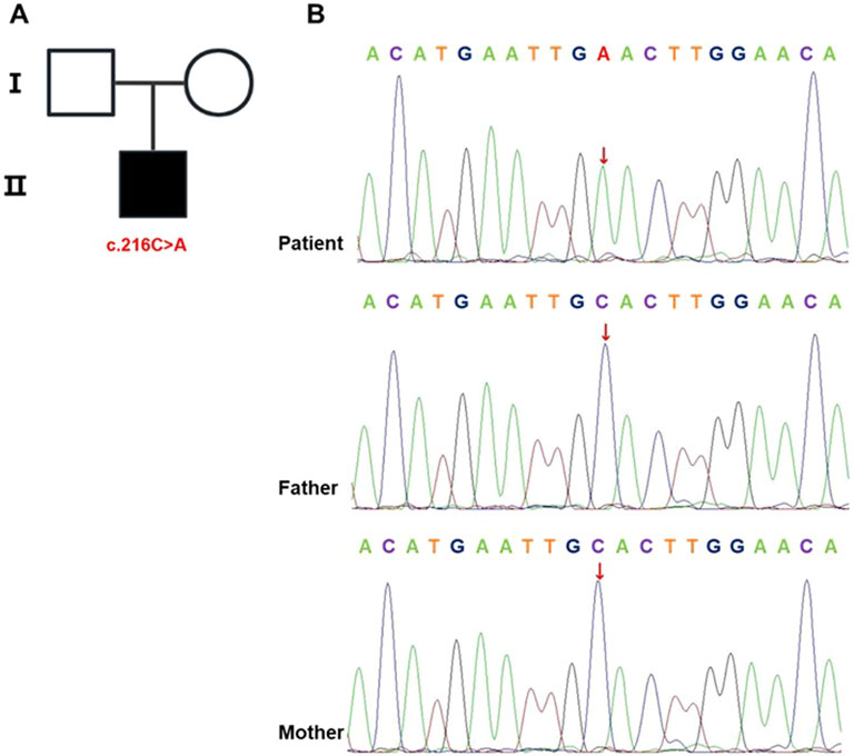 Diagram A shows a family pedigree with three individuals: an unaffected father (square), an unaffected mother (circle), and an affected child (filled square) with a c.216C>A mutation. Diagram B presents DNA sequencing chromatograms for the patient, father, and mother, highlighting the nucleotide sequences with arrows pointing to the mutation site.