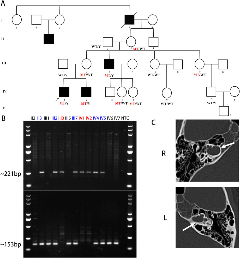 Pedigree diagram (A) displays genetic inheritance patterns, with symbols denoting affected and unaffected individuals. Gel electrophoresis (B) shows DNA bands for samples II2 through NTC, with ∼221 bp and ∼153 bp markers. CT scans (C) reveal abnormalities in right and left ear structures, indicated by arrows.