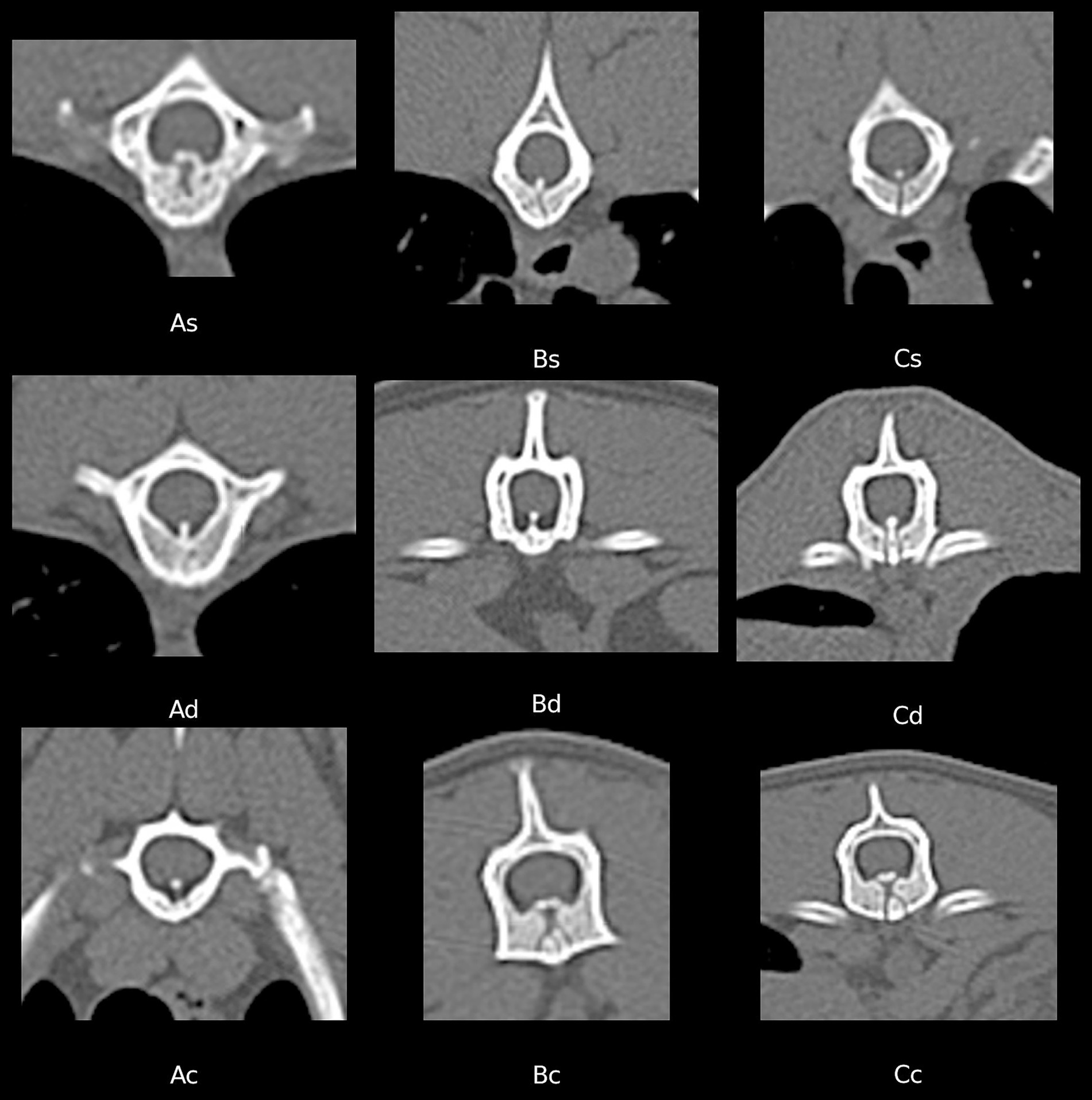 Nine grayscale CT scan images of vertebrae are shown in a 3x3 grid. Each is labeled at the bottom: top row as As, Bs, Cs; middle row as Ad, Bd, Cd; bottom row as Ac, Bc, Cc. Each image presents different transverse views of affected vertebrae.