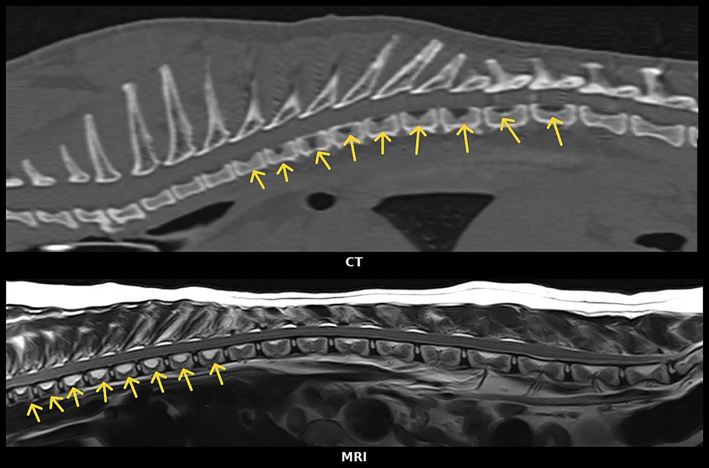 CT and MRI sagittal views of a spinal column side by side, with yellow arrows indicating suspectedvertebrae affect by VVCD along the thoracic spine. The CT scan is above, and the MRI scan below.