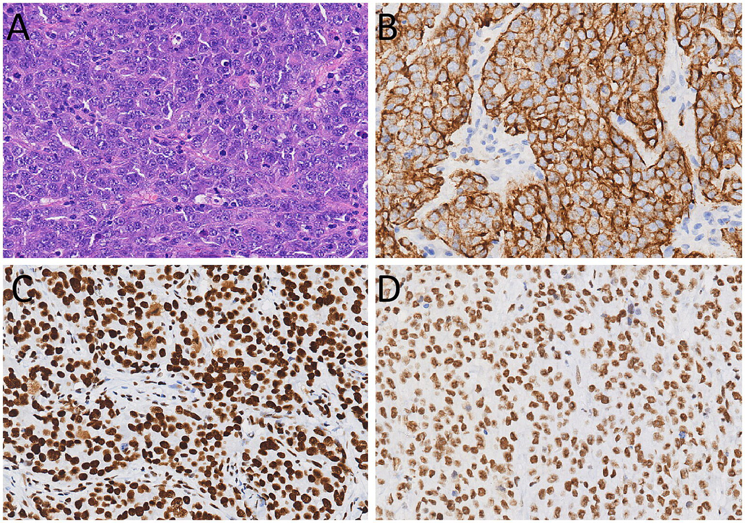 Histological composite image with four panels. Panel A shows tumor cells with nested architecture in hematoxylin and eosin stain. Panel B displays strong CD56 positivity with membrane staining. Panel C shows uniform positivity for synaptophysin with nuclear staining. Panel D exhibits uniform positivity for chromogranin with nuclear staining.