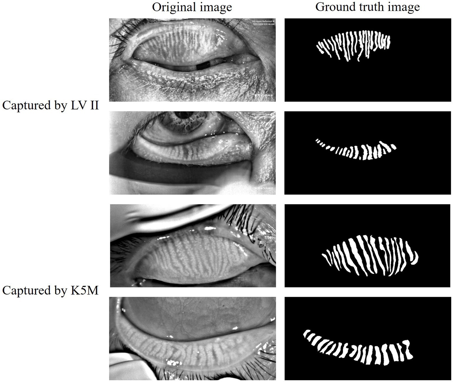 Side-by-side comparison of original and ground truth images of an eyelid, captured using LV II and K5M devices. The original images show detailed textures of the eyelid, while the ground truth images depict binary patterns of the meibomian glands.