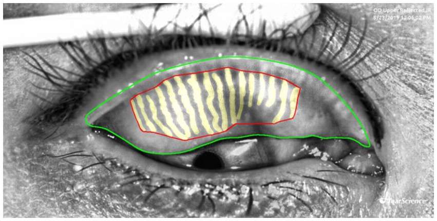 Close-up image of an eye showing a detailed scan with highlighted areas. A large portion of the upper eyelid is outlined in green, while a central area with vertical yellow stripes is outlined in red, indicating distinct regions. The image includes text identifying it as