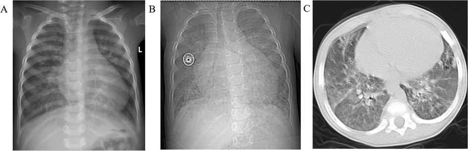 Panel A shows a chest X-ray with clear lung fields and visible ribs. Panel B depicts a chest X-ray with a round, metallic foreign object over the chest area. Panel C displays a CT scan of the chest showing detailed lung tissue and some abnormalities.