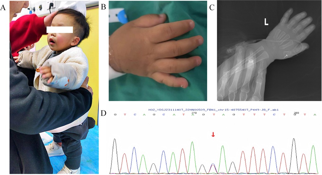 A panel of images showing a young child being held, focusing on their upper body (A); a close-up of the child's hand with five fingers visible (B); an X-ray image of the child's hand, labeled \