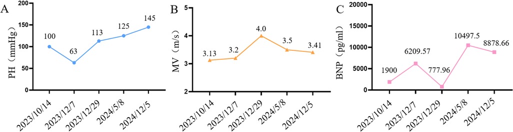 Three line graphs labeled A, B, and C show different measurements over time from October 2023 to December 2024. Graph A shows PH increasing from 100 to 145 mmHg, with a dip in December 2023. Graph B displays MV starting at 3.13 m/s, peaking at 4.0 m/s in December 2023, then decreasing. Graph C shows BNP starting at 1900 pg/mL, peaking at 10497.5 pg/mL in May 2024, then slightly decreasing.