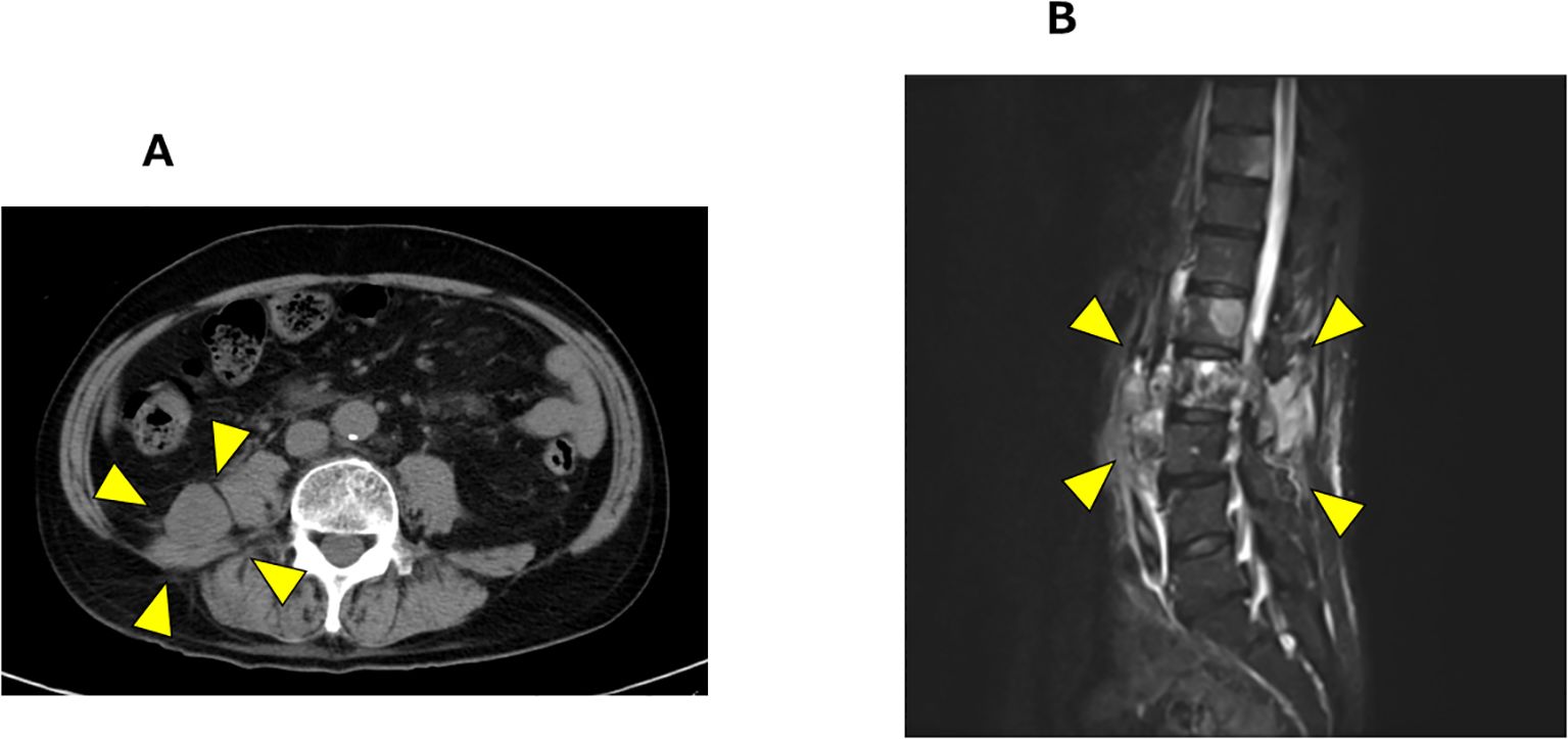 CT scan and MRI image are marked with yellow arrowheads. Panel A shows a transverse abdominal scan highlighting retroperitoneal mass, while Panel B shows a sagittal view of the lumbar spine, with lumbar vertebral metastases.