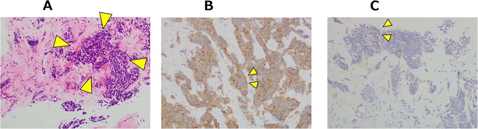 Histological image showing three panels labeled A, B, and C. Panel A displays tissue stained with hematoxylin and eosin, highlighting clusters of cells indicated by yellow arrowheads. Panel B shows that tumor cells are immunohistochemically positive for synaptophysin. Panel C shows that tumor cells are partially positive for chromogranin A. Each panel illustrates a different staining technique used to highlight specific tissue characteristics.