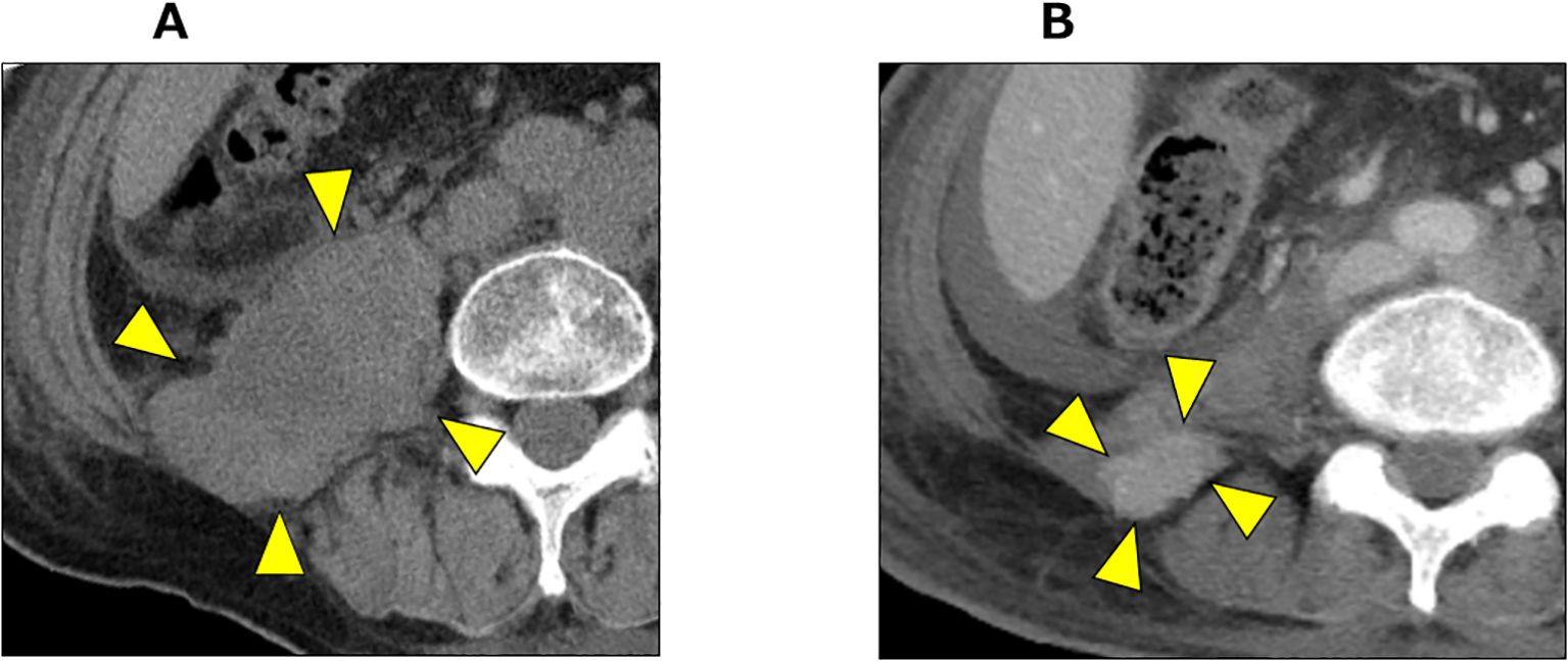 CT scan images labeled A and B show cross-sections of the abdomen. Yellow arrowheads in both images highlight retroperitoneal mass. The retroperitoneal mass shows a tendency to shrink.