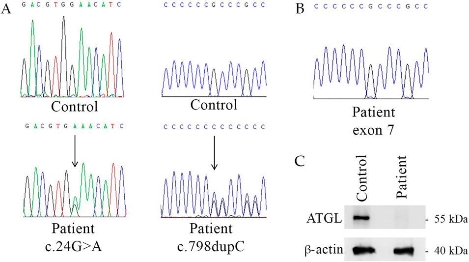 Panel A shows DNA sequencing chromatograms comparing control to patient with mutations c.24G>A and c.798dupC. Panel B depicts RNA exon 7 sequencing for a patient. Panel C presents a Western blot comparing ATGL and β-actin protein levels between control and patient, indicating the absence of ATGL in the patient sample.