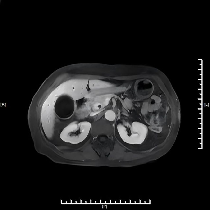 MRI scan of an abdominal cross-section showing internal organs, including the kidneys, surrounded by various tissues. The image features anatomical details in grayscale with measurement scales on the sides indicating orientation.