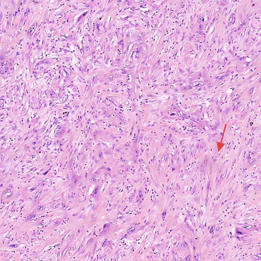 Histological tissue section showing a dense, swirling pattern of spindle-shaped cells stained in pink and purple. An arrow points to a specific area, indicating a focus of interest.