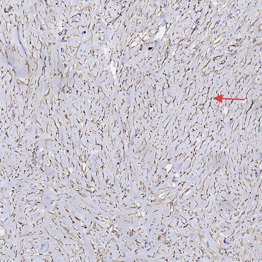 Histological image showing a densely packed arrangement of spindle-shaped cells with elongated nuclei. A red arrow points to a specific area within the tissue. The background is a pale purple, typical of staining techniques.