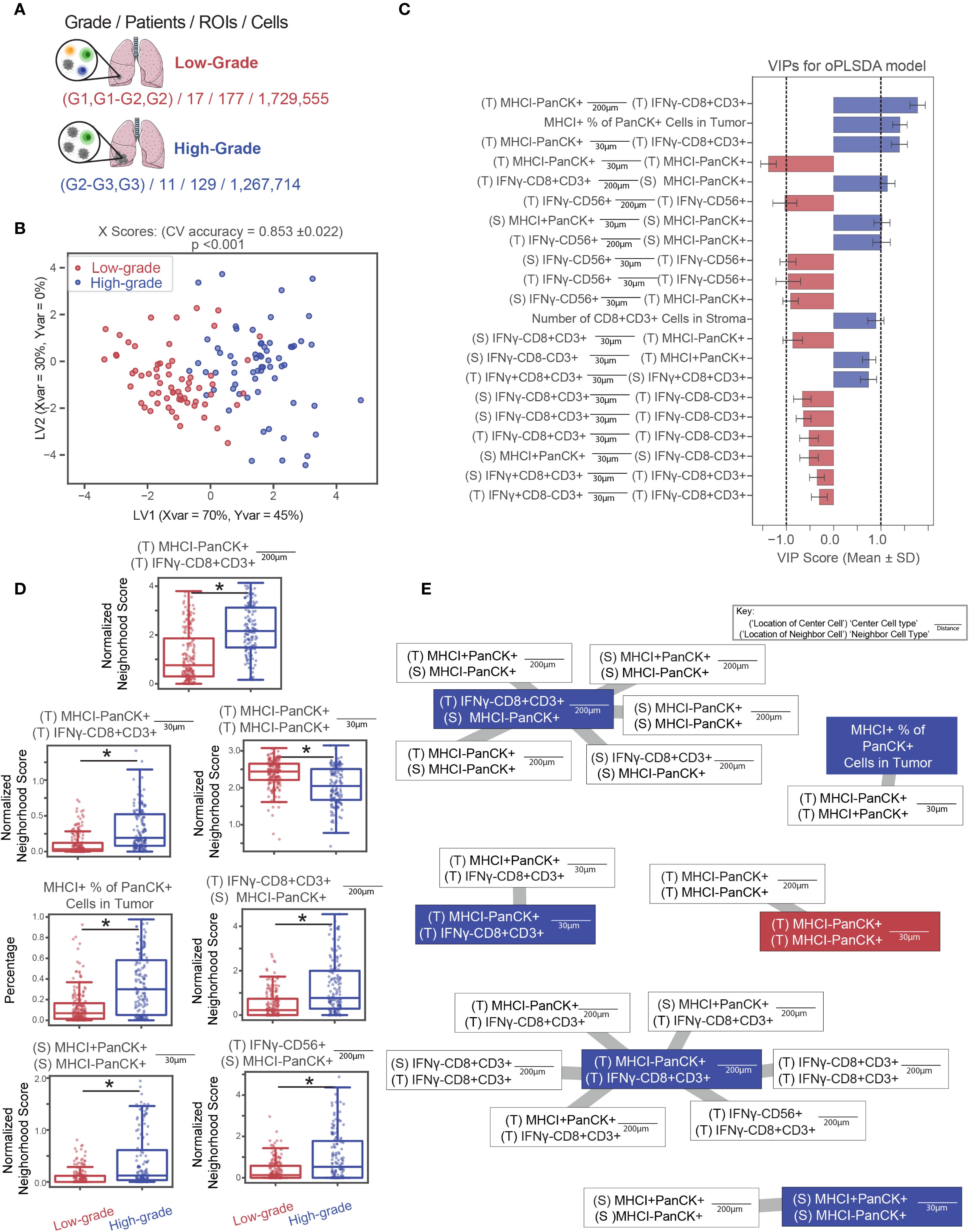 Diagram illustrating analysis of tumor grades with multiple components: A shows the distribution of grades, patients, ROIs, and cells; B provides a scatter plot differentiating low-grade and high-grade cases; C features a bar graph of VIP scores for an OPLSDA model; D contains box plots comparing neighborhood scores across cell types; E displays a schematic of relationships with correlations with a legend.
