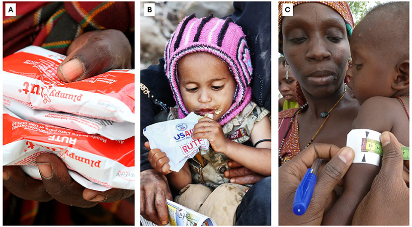 Panel A shows a close-up of hands holding packages of Plumpy’Nut, a nutritional supplement. Panel B depicts a young child in a pink hat eating from a RUTF (Ready-to-Use Therapeutic Food) packet. Panel C shows a child being measured using a mid-upper arm circumference tape by an adult, with another adult holding the child.