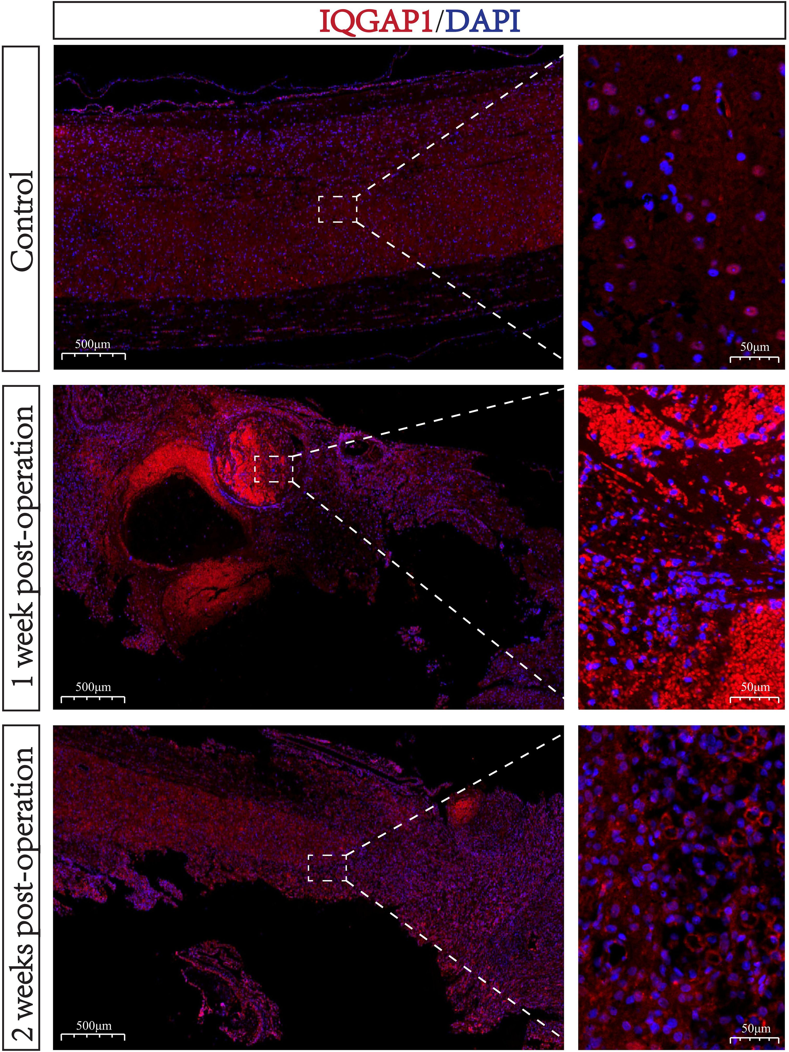 Fluorescence microscopy images showing IQGAP1 and DAPI staining. The top row is a control sample with dense red and blue staining. The middle row represents tissue one week post-operation, showing increased red fluorescence. The bottom row depicts tissue two weeks post-operation with widespread staining. Each row includes a high-magnification inset detailing cellular structures, revealing variations in staining intensity and distribution over time. Scale bars are 500 micrometers for the main images and 50 micrometers for the insets.