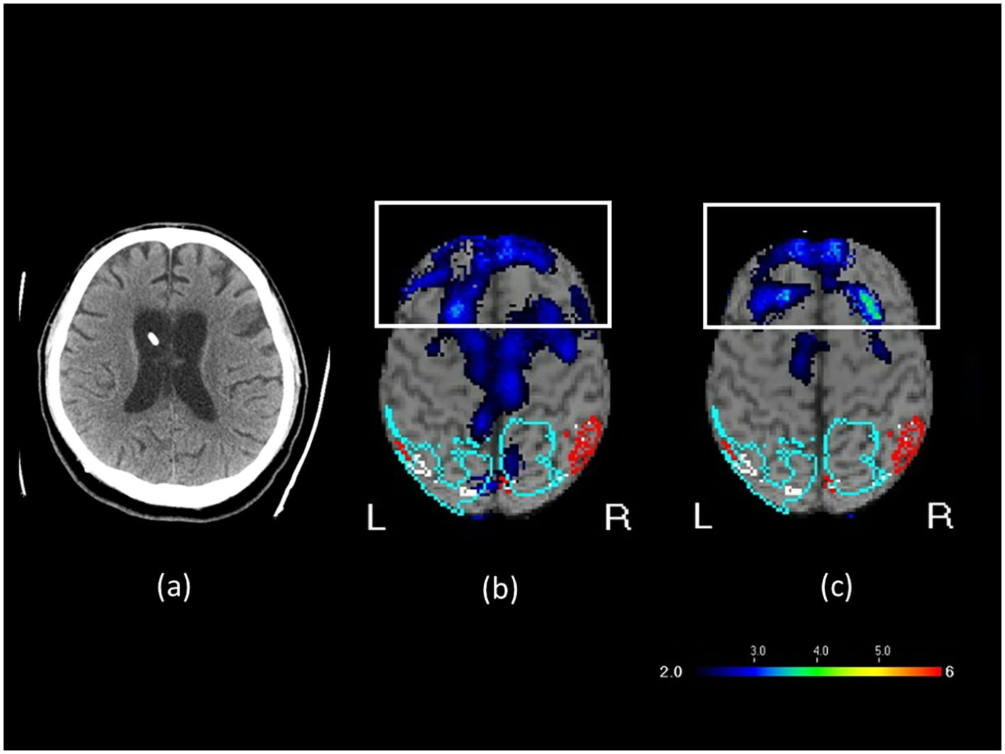 CT and MRI brain scans comparing different images. Image (a) is a CT scan showing normal brain structures. Images (b) and (c) are MRI scans with highlighted areas in blue and red, indicating regions of interest. A color scale ranges from blue (2.0) to red (6.0) measurement units at the bottom.