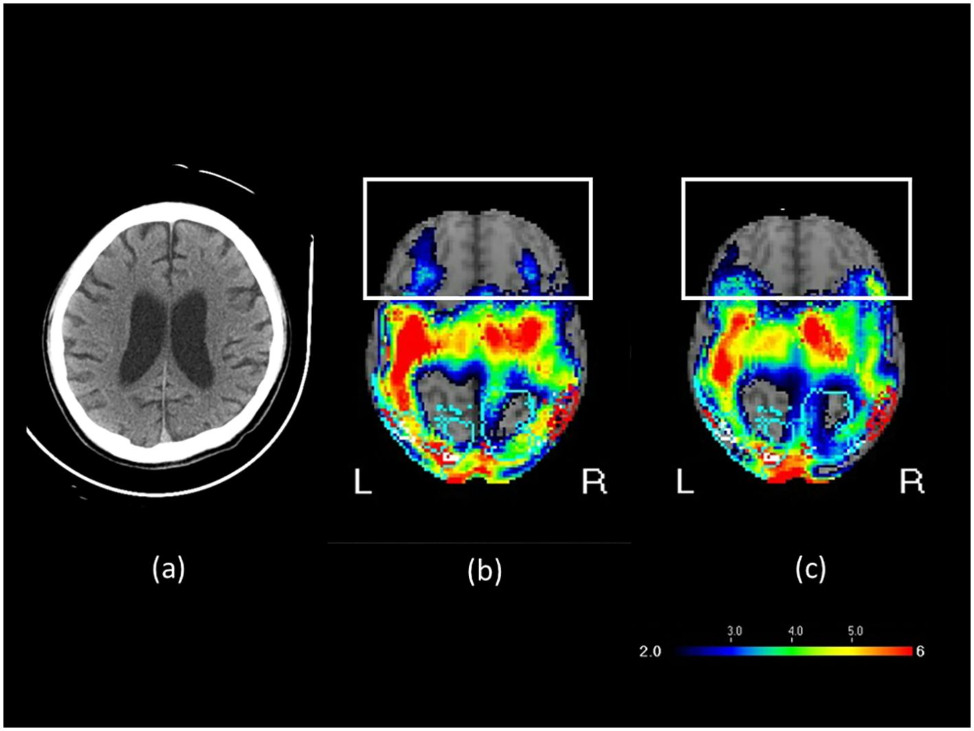CT and MRI images of a brain are shown. Image (a) is a grayscale CT scan detailing brain structure. Images (b) and (c) are colored MRI scans, highlighting brain activity with a color spectrum from blue to red. The scale below indicates intensity levels from 2.0 to 6.0. Labels L and R denote left and right.
