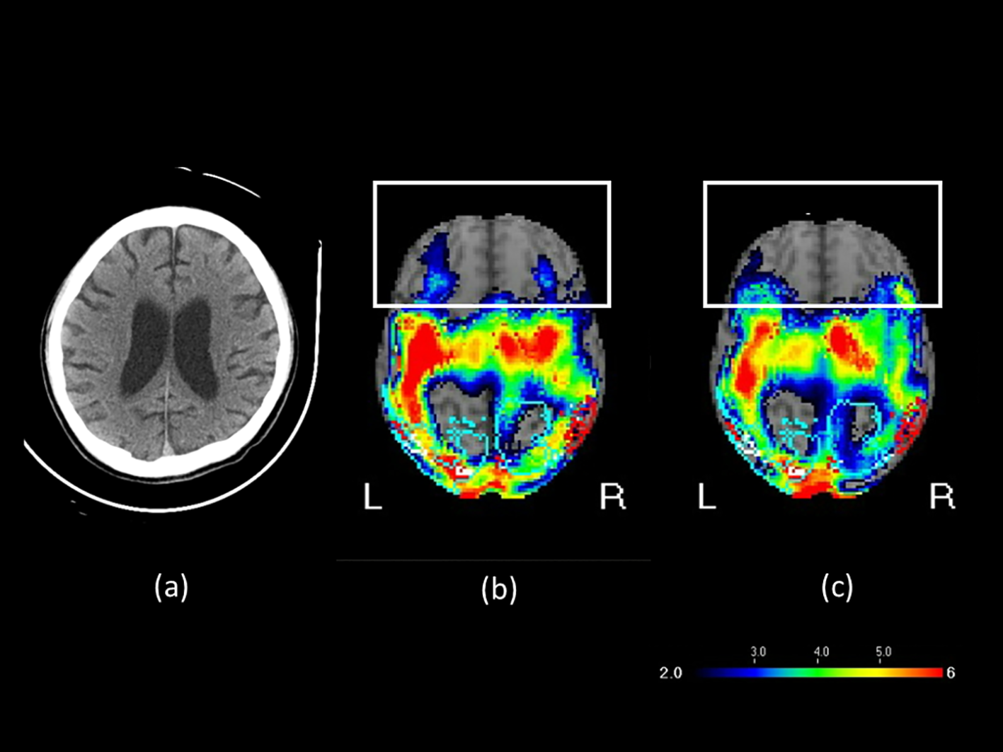 CT and MRI images of a brain are shown. Image (a) is a grayscale CT scan detailing brain structure. Images (b) and (c) are colored MRI scans, highlighting brain activity with a color spectrum from blue to red. The scale below indicates intensity levels from 2.0 to 6.0. Labels L and R denote left and right.