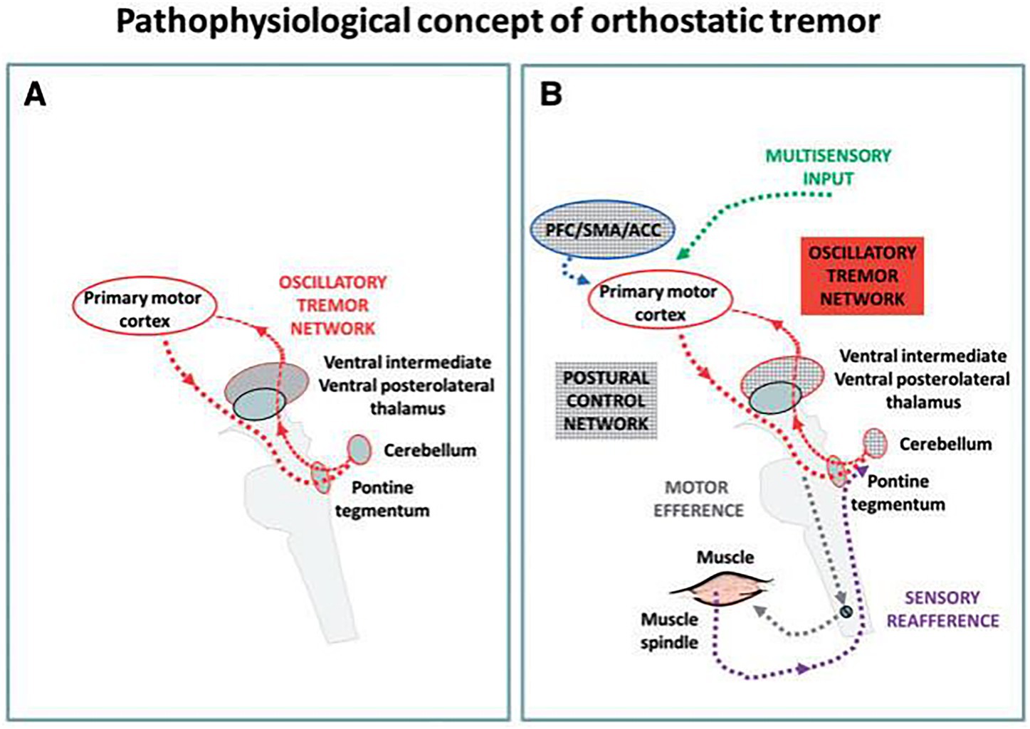 Diagram illustrating the pathophysiological concept of orthostatic tremor. Panel A shows the oscillatory tremor network involving the primary motor cortex, ventral intermediate, ventral posterolateral thalamus, cerebellum, and pontine tegmentum. Panel B adds multisensory input and postural control network, highlighting motor efference and sensory reafference involving muscles and muscle spindles.