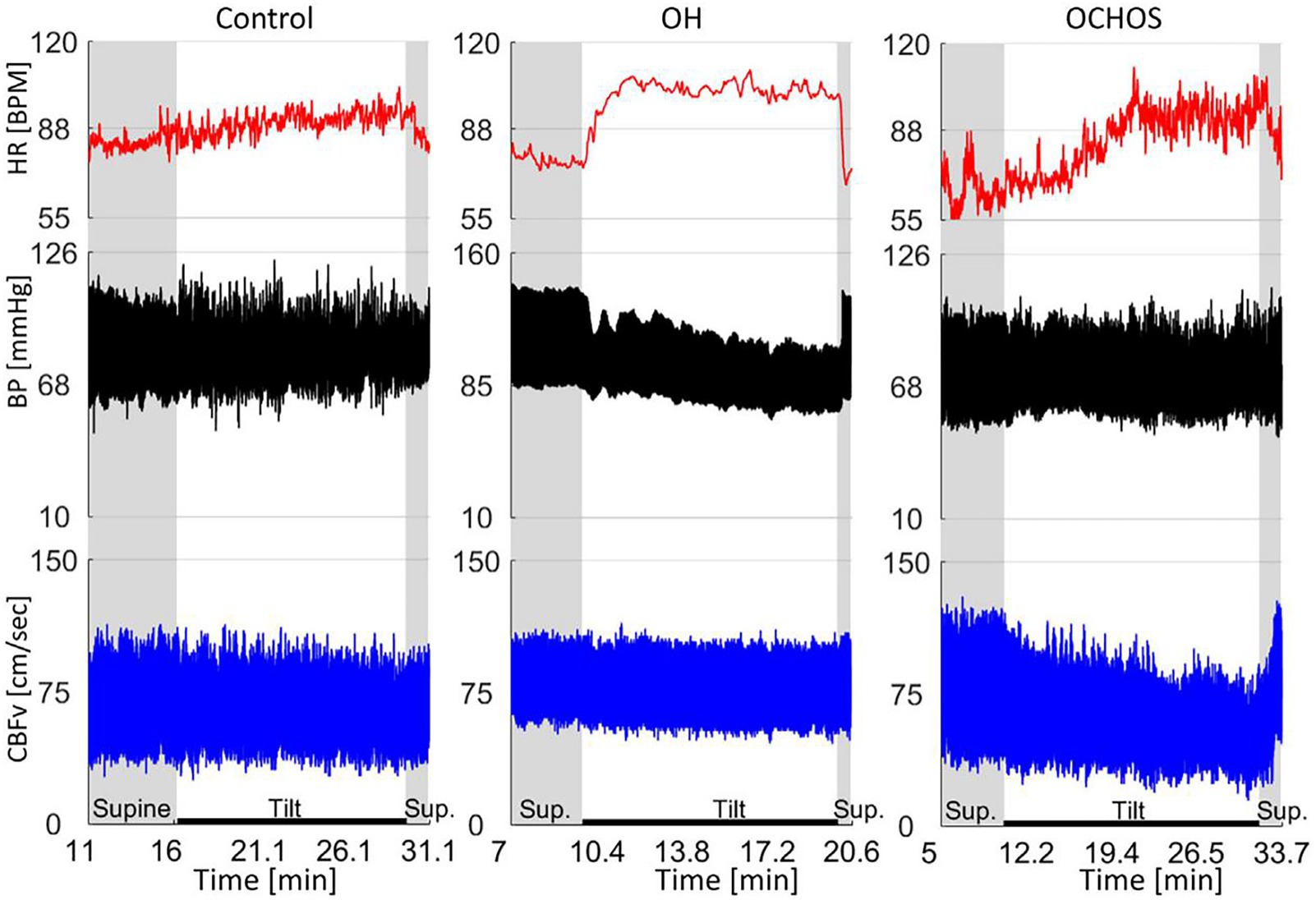 Three-panel graph showing heart rate (red), blood pressure (black), and cerebral blood flow velocity (blue) over time during different phases: supine, tilt, and supine recovery. Panels compare control, orthostatic hypotension (OH), and OCHOS conditions, highlighting variations in each metric across phases.
