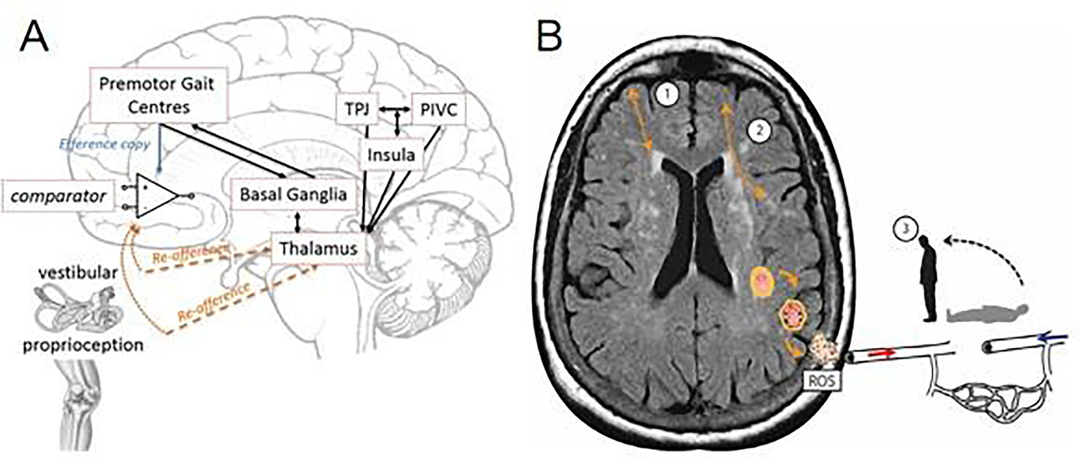 Diagram A shows a brain pathway related to movement, including premotor gait centers, basal ganglia, thalamus, insula, TPJ, and PIVC, with input from vestibular and proprioception systems. Diagram B displays a brain MRI with highlighted areas and an illustration of a person falling, indicating a connection between these brain regions and balance or movement issues.