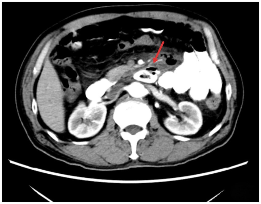 CT scan of the abdominal region showing a transverse section. A red arrow indicates a specific area of interest, possibly highlighting an anomaly or point of diagnosis. Various organs and tissues are visible in grayscale tones.