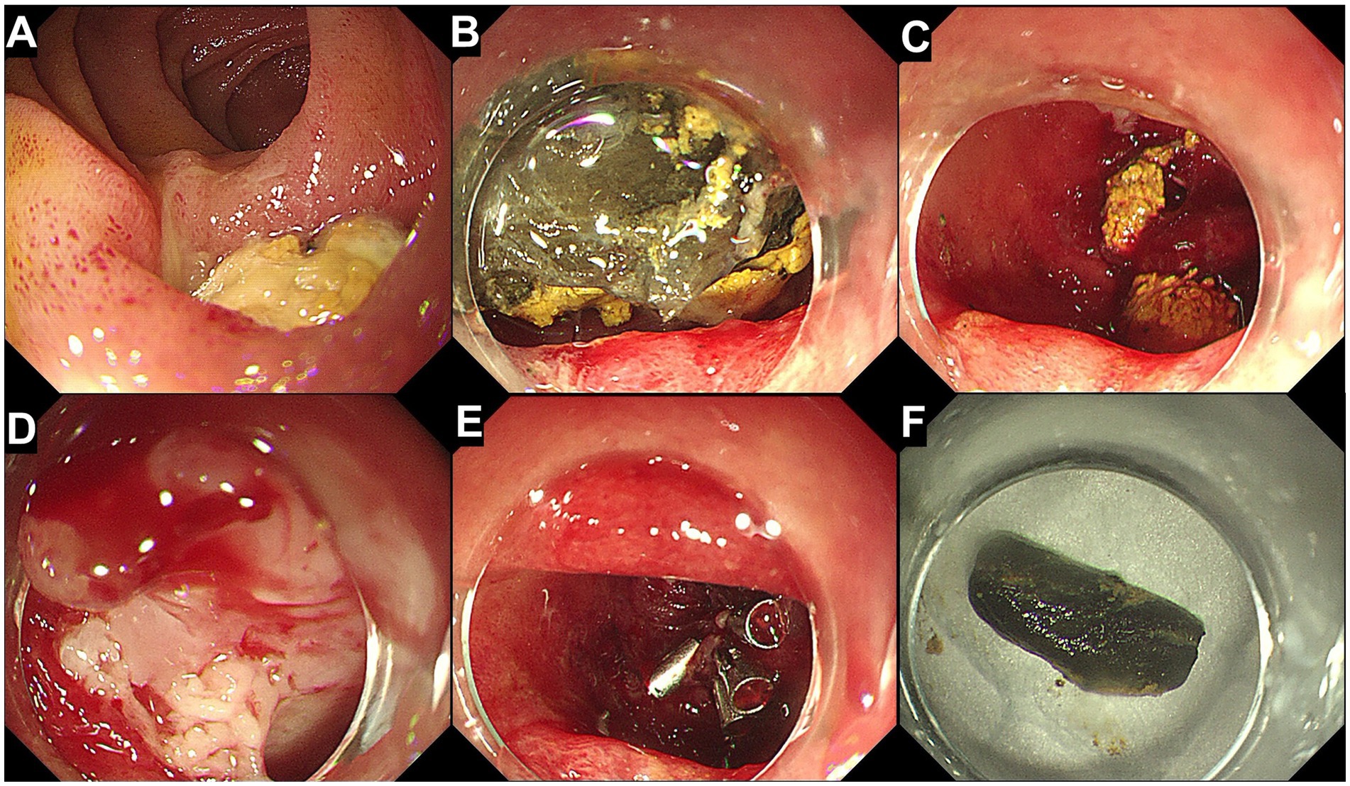 Six endoscopic images show different stages of an esophageal bezoar extraction. Image A shows the bezoar lodged in the esophagus. Image B displays the endoscope inserted with partial coverage by the bezoar. Image C reveals partial removal with remaining debris. Image D shows a nearly cleared esophagus with some residual matter. Image E captures the final stage of cleansing. Image F depicts the extracted bezoar outside the body.