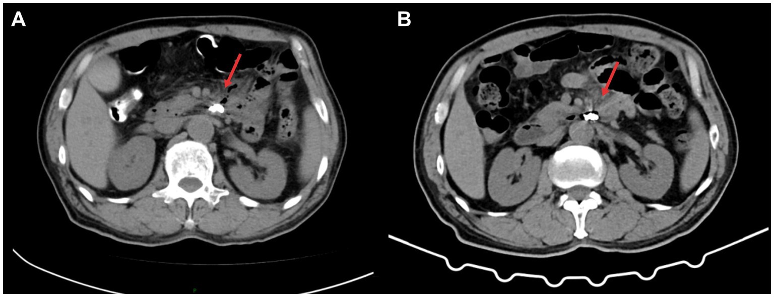 Two CT scan images labeled A and B showing abdominal cross-sections. Both images highlight a specific area with red arrows, indicating a point of interest within the abdominal cavity. Organs and other anatomical structures are visible, with varying shades of gray and white, contrasting the highlighted areas.