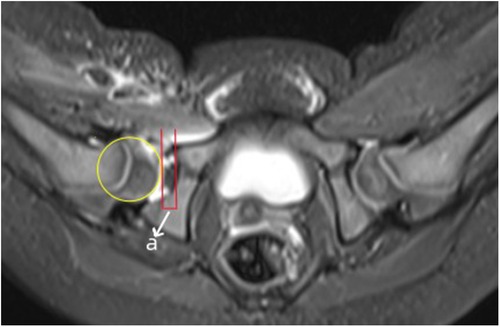 Axial MRI scan of the pelvis showing a highlighted hip joint. A yellow circle outlines the femoral head, and two parallel red lines mark the acetabular region, with an arrow labeled “a” indicating measurement reference.
