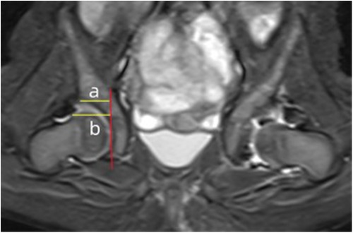 Coronal MRI of the pelvis showing bilateral hip joints. Yellow horizontal lines labeled “a” and “b” mark reference points across the left hip, while a vertical red line indicates the acetabular margin for measurement comparison.