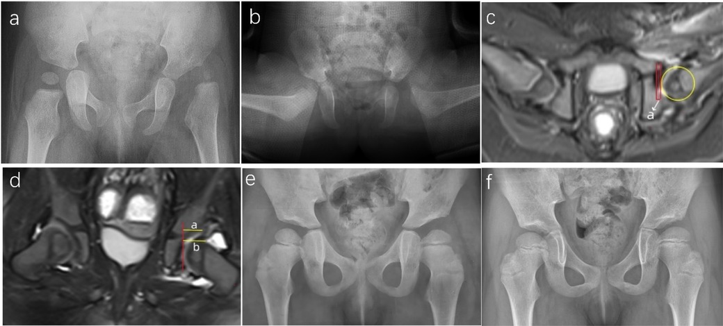 Panel a shows anteroposterior pelvic radiograph of a child with hip dislocation. Panel b is a lateral radiograph confirming displacement. Panel c is an axial MRI with a yellow circle outlining the femoral head and a red line marking acetabular reference, with arrow “a” indicating measurement. Panel d is a coronal MRI with yellow lines labeled “a” and “b” marking distances relative to the acetabulum. Panel e is a follow-up radiograph showing post-treatment hip alignment, and panel f displays a later radiograph with improved bilateral hip joint positioning.