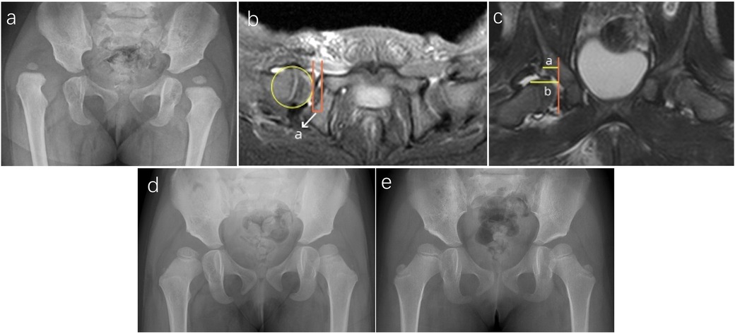 Panel a shows an anteroposterior pelvic radiograph demonstrating bilateral hip dislocation. Panel b is an axial MRI with the femoral head circled in yellow, red lines marking the acetabular margin, and arrow “a” indicating measurement. Panel c is a coronal MRI with yellow lines labeled “a” and “b” for acetabular reference distances. Panels d and e are follow-up pelvic radiographs showing postoperative improvement in hip alignment and acetabular development.
