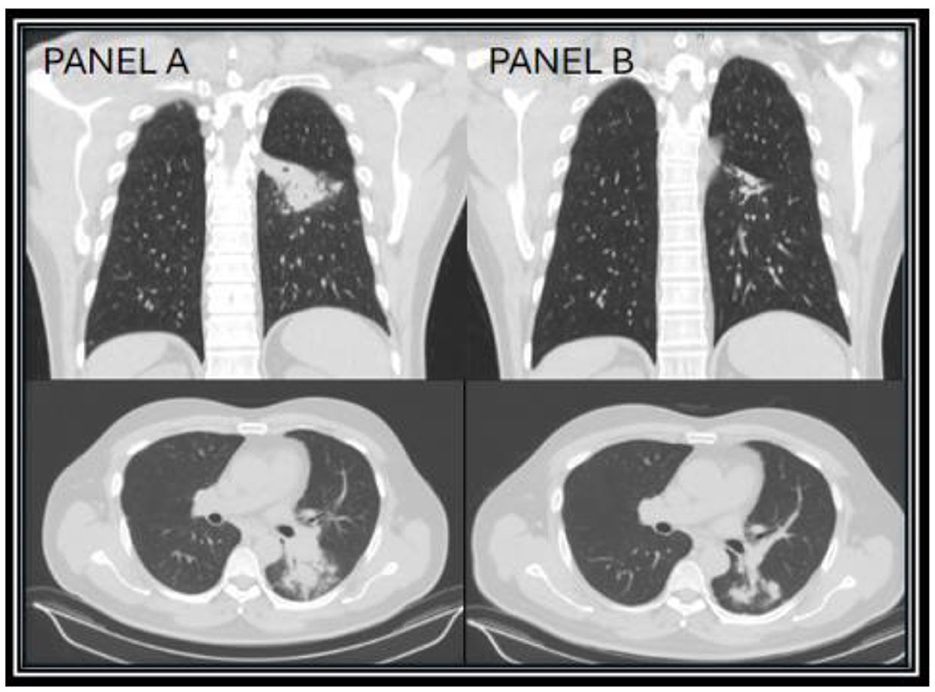 CT scan images showing the lungs in coronal and axial views labeled “Panel A” and “Panel B.” Panel A displays more pronounced areas of abnormality in the lower lobe of the right lung compared to Panel B. Both panels show differences in lung opacity and structure.