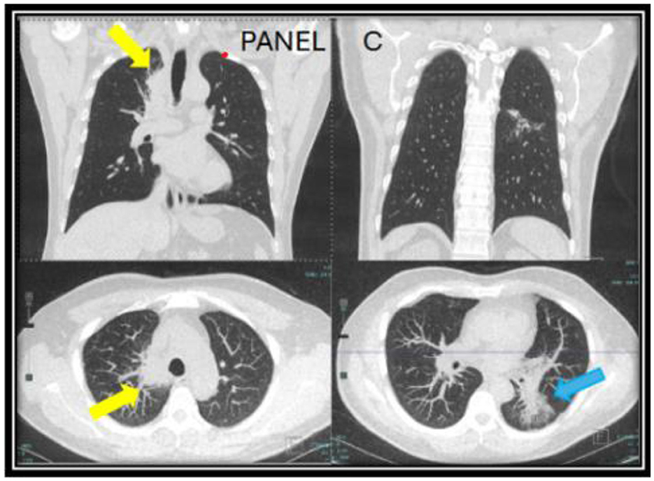 Medical CT scan image with four panels showing cross-sections of the lungs. The left side, labeled “Panel,” has yellow arrows indicating specific areas in the upper and lower scans. The right side, labeled “C,” shows a normal lung cross-section with a blue arrow highlighting a region in the lower scan.